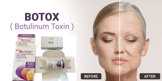 type botulinum de toxine de 100Units Allergan une injection pour le retrait facial de ride