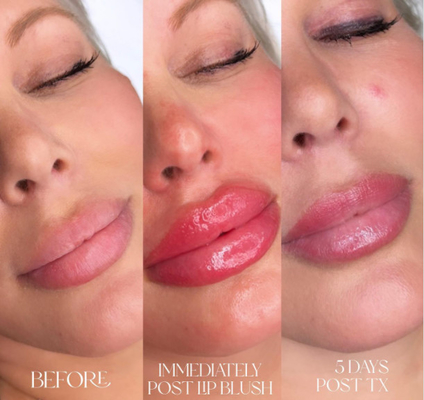 Remplisseurs cutanés des lèvres 2ml d'acide hyaluronique profond de Skinject injectables