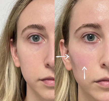 Remplisseurs cutanés des lèvres 2ml d'acide hyaluronique profond de Skinject injectables