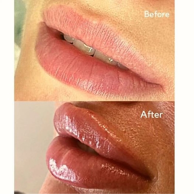 Injection injectable Juvederms de remplisseur remplisseur cutané d'ultra 3 ha pour le volume de lèvre