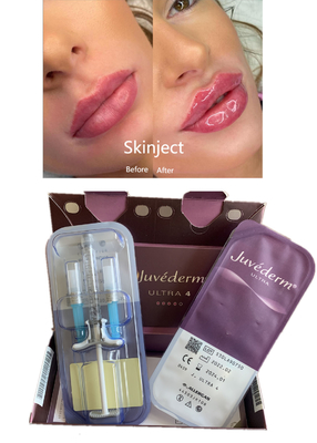 Les lèvres remodèlent le remplisseur cutané d'acide hyaluronique de Juvederm avec la piscine découverte Ultra4 2X1ml