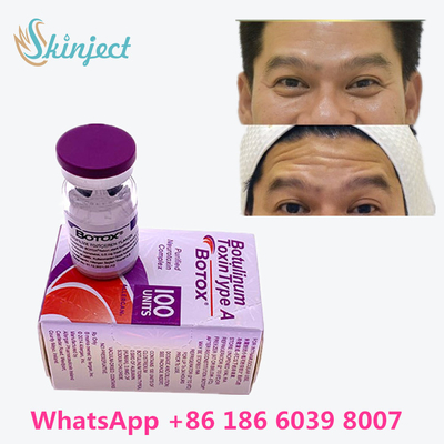 Toxine botulinum Allergan anti-vieillissement  sur la ligne anti ride d'achat