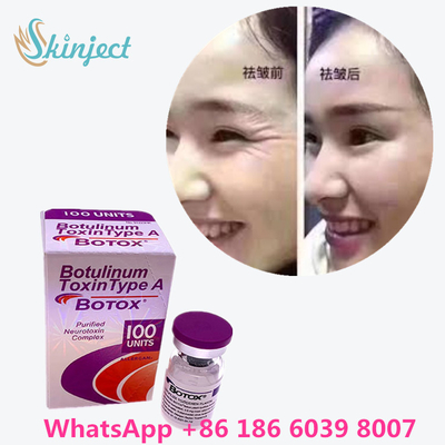 La toxine botulinum  rident le retrait 100u Allergan 100 unités pour l'injection de lifting
