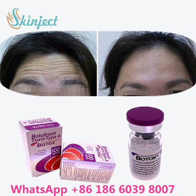 La toxine botulinum  rident le retrait 100u Allergan 100 unités pour l'injection de lifting
