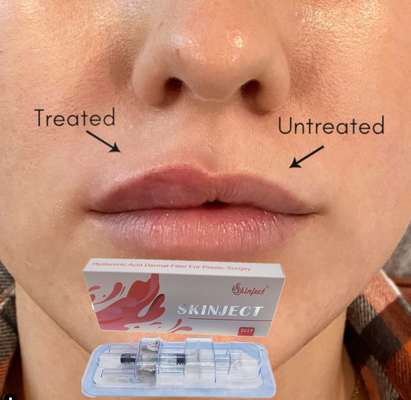 Joue cutanée Chin Nasolabial Fold de remplisseur de la lèvre 2ml d'acide hyaluronique profond injectable