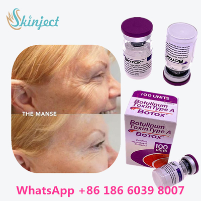 La toxine botulinum Allergan  dactylographient emballage de la fiole 100units un 1/boîte