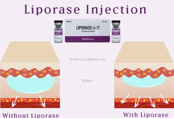 Hyaluronidase de 10 Vias Liporase pour que le remplisseur cutané dissolve
