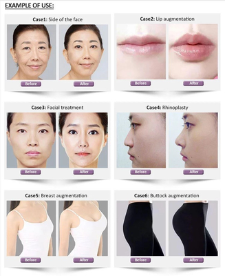 remplisseur cutané hyaluronique profond de 1.1ml Revolax pour le visage