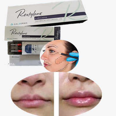 Remplisseur cutané à base d'acide hyaluronique pour augmenter les lèvres du sein