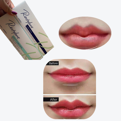 2*1 ml/ boîte de remplissage cutané croisé pour augmentation des lèvres