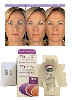 Injections Allergène Botulinum Toxin 100 UI Remplisseur cutané anti-rides