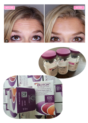 Anti-rides Toxine botulique Allergan 100IU 150iu Injections de