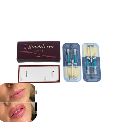 Juvederm Remplisseur cutané pour lèvres Remplisseurs d'acide hyaluronique injectables