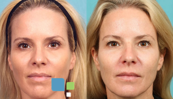 Remplisseur injectable 3D PLLA pour la régénération du collagène du visage