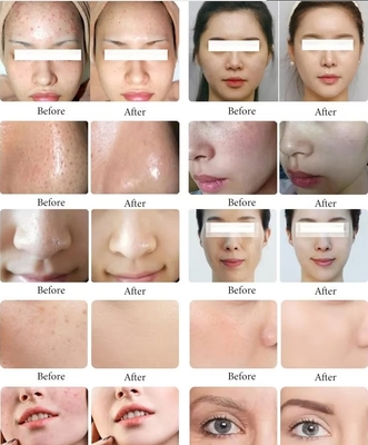 Nouvelle arrivée Perle Noire 10 en 1 Hydra Peeling Machine Microdermabrasion Machine Spa du visage Micro-touch Hydra soins de la peau