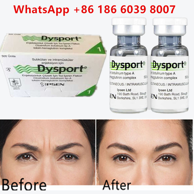 Toxine botulique: un dysport pour les rides et les rides entre les sourcils