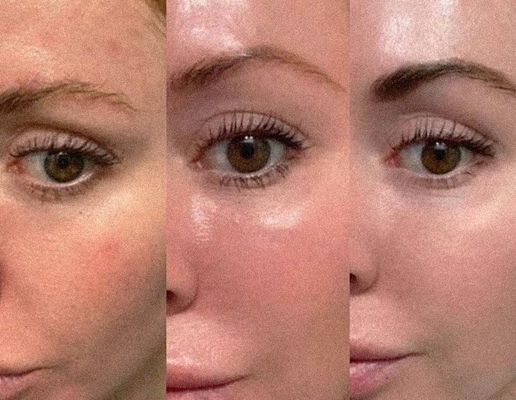 Stimulation du collagène Profhilo Remplisseur cutané injectable