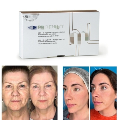 Fil de lifting 5 points Profhilo, produit de comblement injectable pour la peau, effet naturel