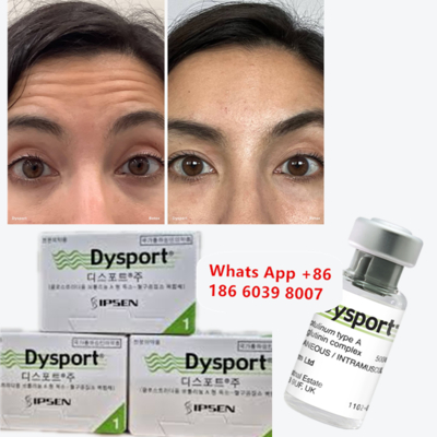 Toxine botulique dysportive de type A pour les lignées frown et glabelaires