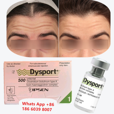 Injection anti-rides à la toxine botulique de type A Dysport pour les rides péribuccales