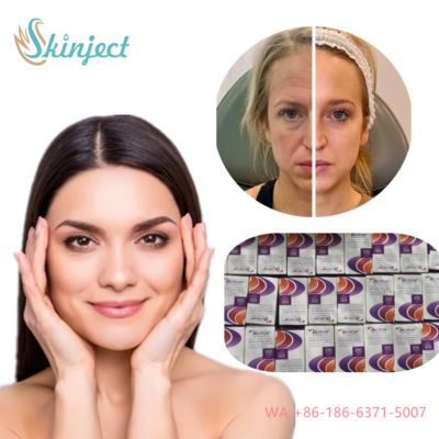 Allergan Botox Nobota 100u 200u pour un traitement efficace des franges du visage Injections de toxine botulique