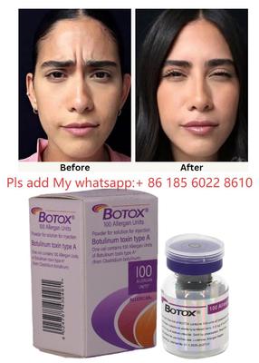Toxine Botulique Allergan Botox 100UI Injection - Réduire les signes de l'âge avec Allergan