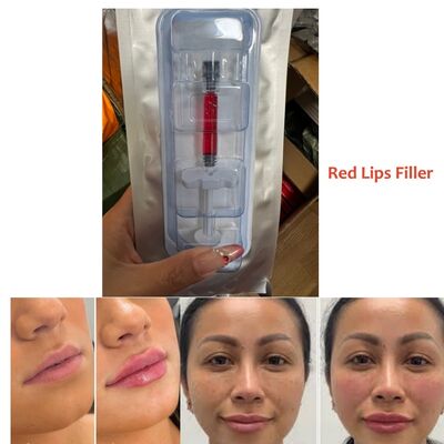 Injection de comblement dermique pour le volume des lèvres rouges pour salons, cliniques et esthéticiennes