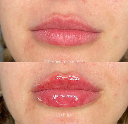 Durée de conservation 2 ans Gel injectable à remplissage cutané conçu pour réduire les rides, contourner le visage et revitaliser la peau