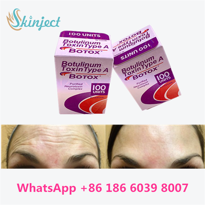 Toxine botulique allergène BOTOX injection cosmétique 100 unités pour les lignées glabellaires