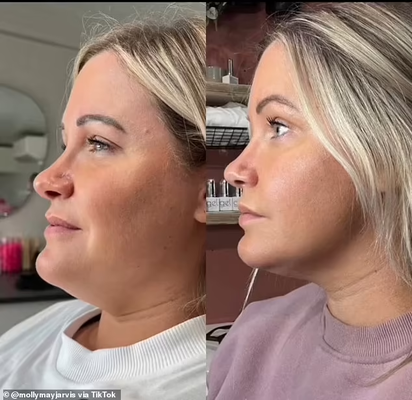 Solution lipolytique Bouteille de citron injections dissolvant les graisses