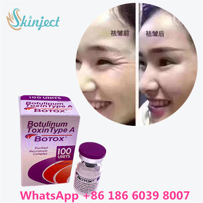 Toxine botulique allergène Botox poudre blanche Traitement efficace des rides du visage et de la relaxation musculaire en médecine