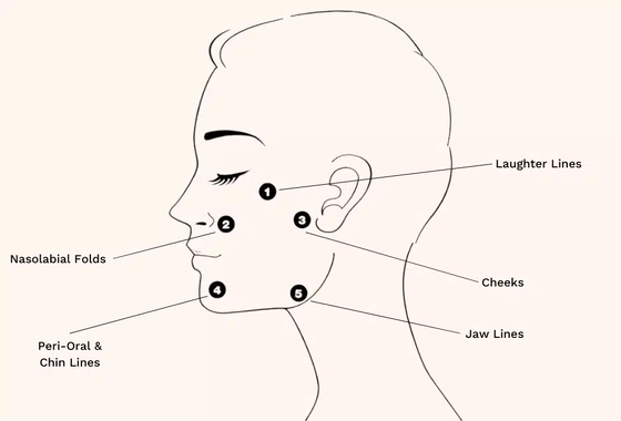 Traitement Profhilo : acide hyaluronique, booster de peau et bio-remodelage