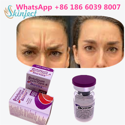 Toxine botulique BOTOX Cosmétique 100 Unités Allergène OnabotulinumtoxinA pour les rides du visage