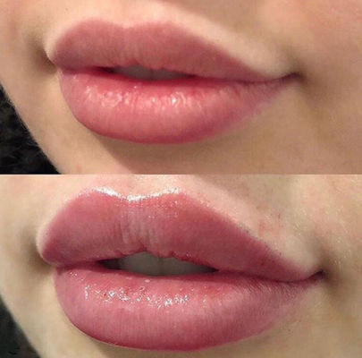 Lèvres russes Juvederm ultra 3 avec le remplisseur cutané lié par croix de lidocaïne