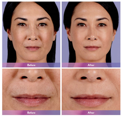 Injection cutanée de lèvre de remplisseur de Juvederm ultra 4 pour l'élargissement de lèvre