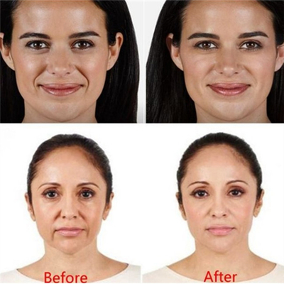 Injection faciale d'hyaluronidase de Juvederm Voluma de remplisseur d'acide hyaluronique