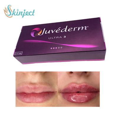 Remplisseur Juvederm Ultra3 de lèvre de l'acide hyaluronique 281ML cutané