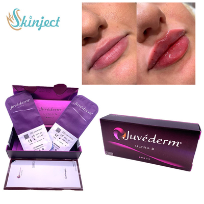 Acide hyaluronique cutané Nasolabial Juvederm Ultra3 de remplisseur des lèvres 2x1ml de plis