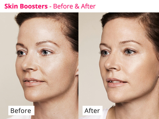 Peau rajeunissant le sérum meso de PDRN Skinbooster pour la régénération de collagène