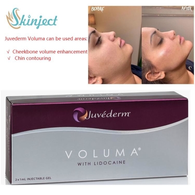 Remplisseurs cutanés d'acide hyaluronique de Juvederm Voluma 2x1ml pour la pommette