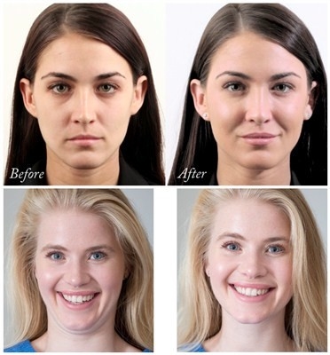 Remplisseur facial d'acide hyaluronique de Juvederm Voluma de hausse 24 mg/ml