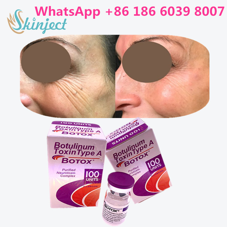 La toxine botulinum Allergan  dactylographient emballage de la fiole 100units un 1/boîte