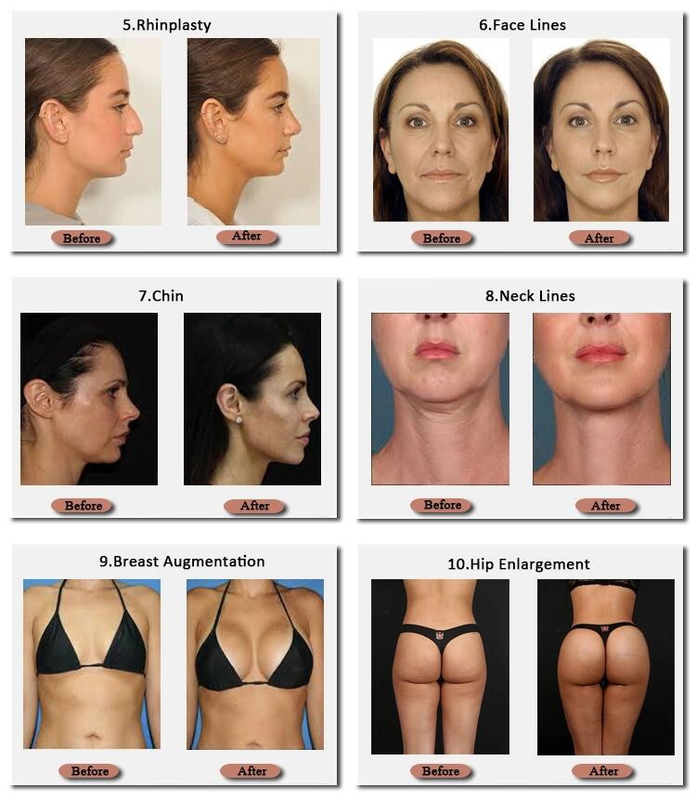 Skinjection remplisseur hyaluronique Technnology coréen de sein de 10 ml et de 20 ml 24 mg/ml