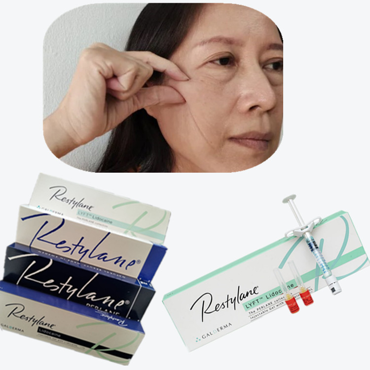 Remplisseur cutané cosmétique HA pour les coins de la bouche