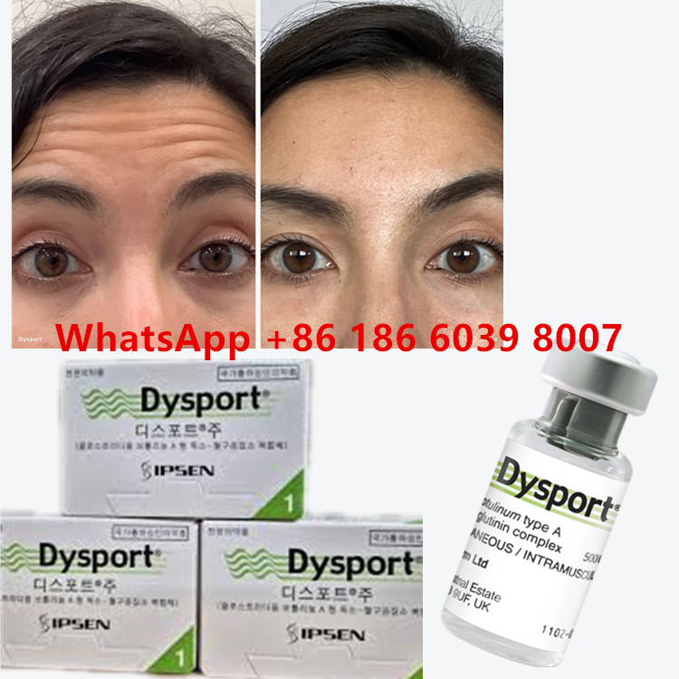 Dysport de la toxine botulique Clostridium Botulinum type A 500 unités/ flacon Pour les rayures du visage