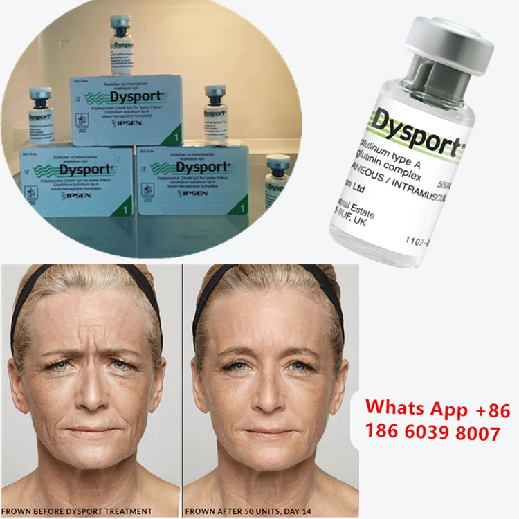 Dysport 500u Toxine Botulique de Type A pour l'Amélioration des Joues