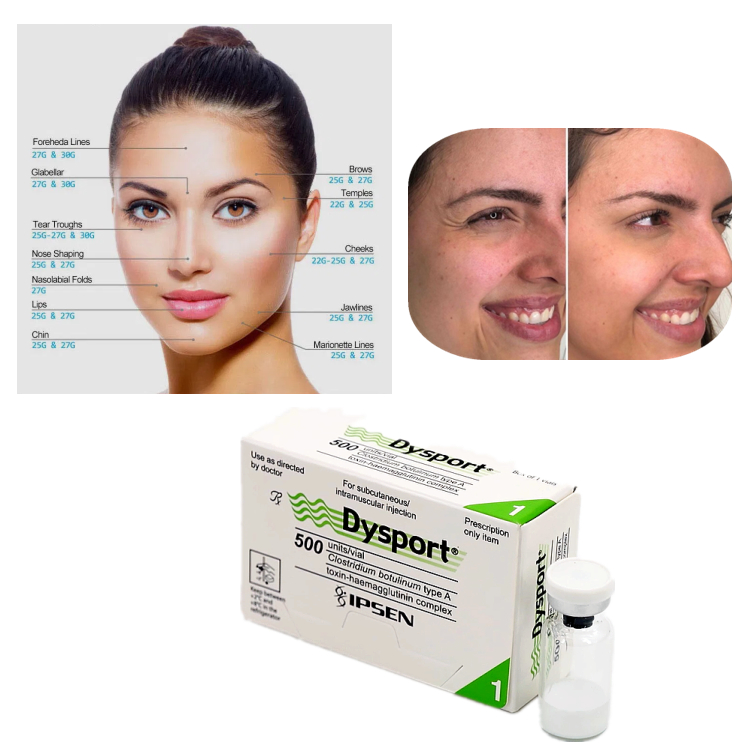 Dysport 500U Toxine Botulique de Type A pour le Traitement des Rides
