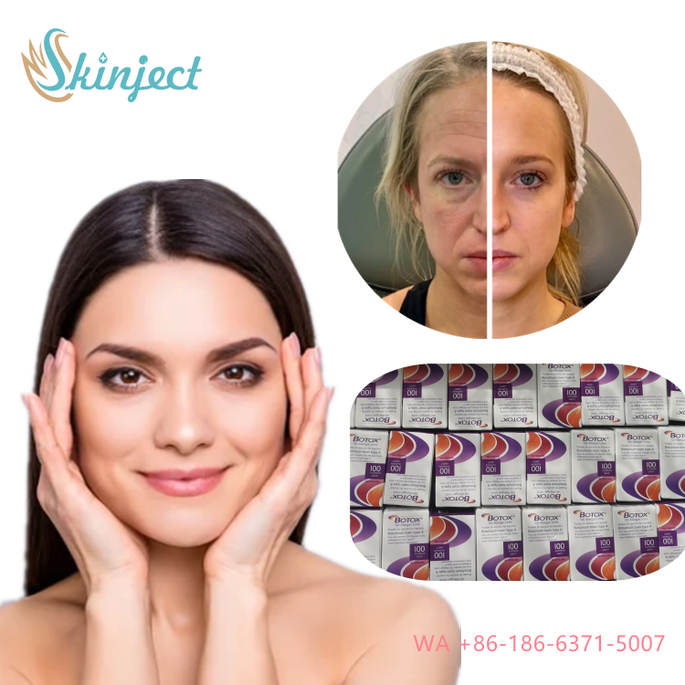 Allergan Botox Nobota 100u 200u pour un traitement efficace des franges du visage Injections de toxine botulique