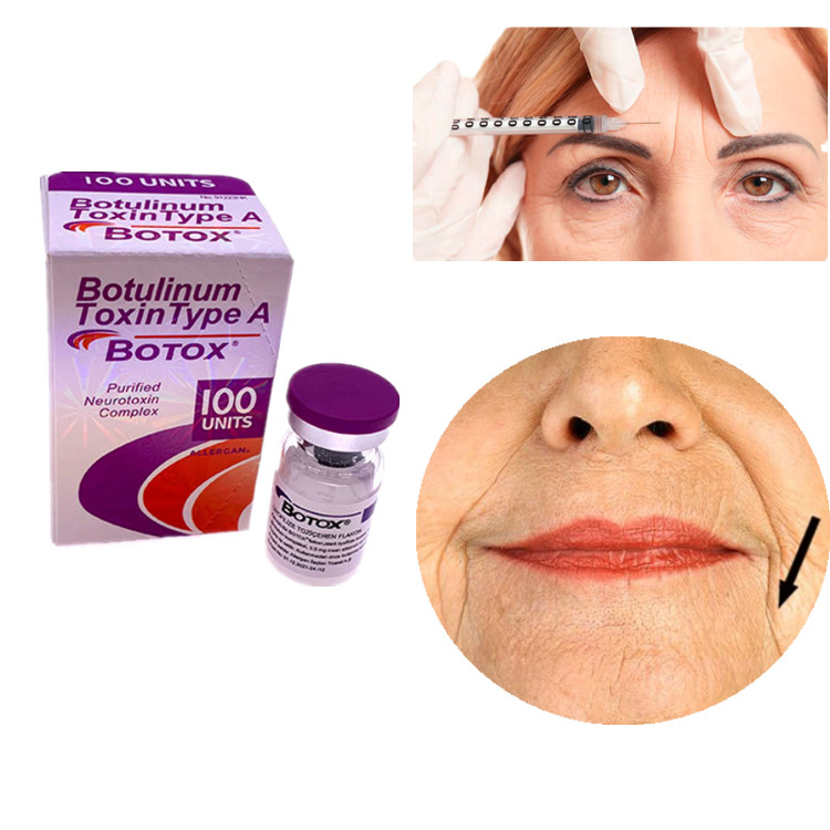 Allergan Botox 100 UI Toxine botulique de type A Pour éliminer les rides du visage et des yeux
