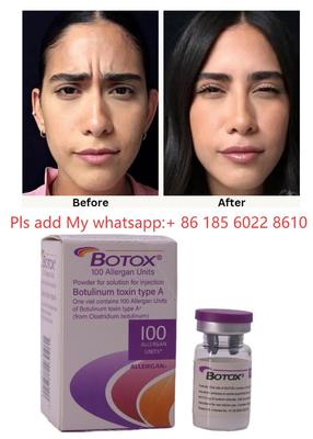 ALLERGAN Injection de Botox Toxine Botulique de Type A